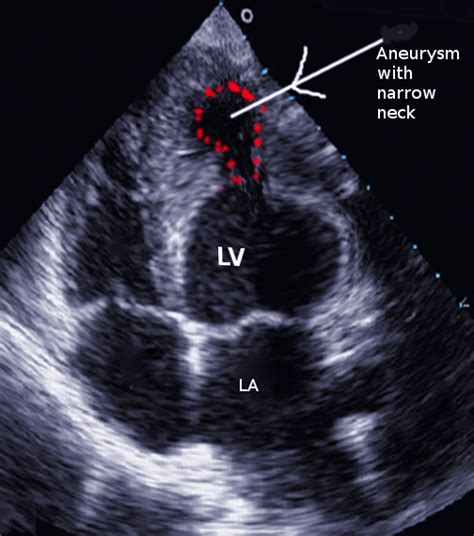 lv aneurysm vs pseudoaneurysm echo.